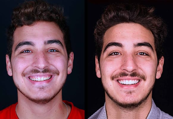 microcarillas-dentales-paciente-real-murcia